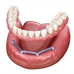 8 dentalpremier.roproteza dentara