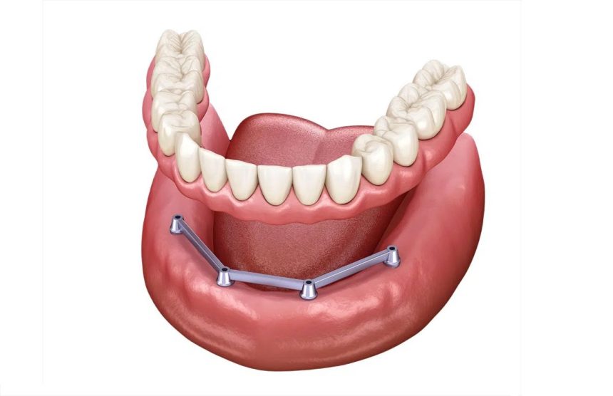 8 dentalpremier.roproteza dentara