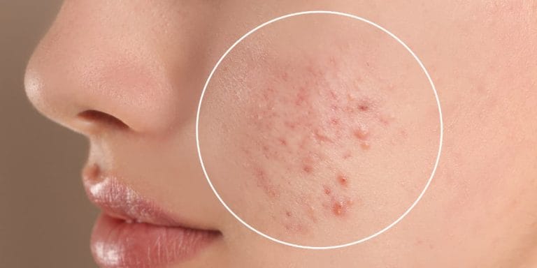 Acnee – Cauze, Tratamente, Remedii Naturale și Sfaturi Locale Acnee – Cauze, Tratamente, Remedii Naturale și Sfaturi Locale