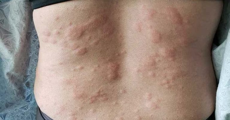 Urticaria