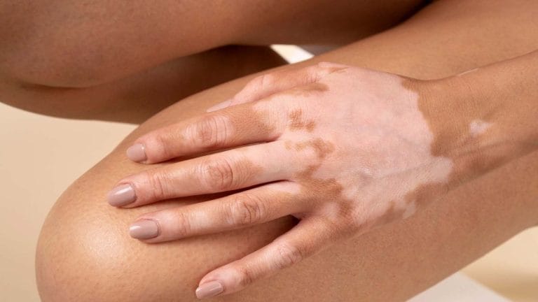 Vitiligo: Cauze, Simptome, Tratamente și Soluții Vitiligo
