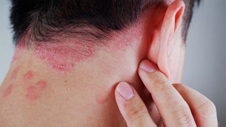 Psoriazisul explicat: simptome, factori declanșatori și opțiuni de tratament psoriazis simptome și tratament
